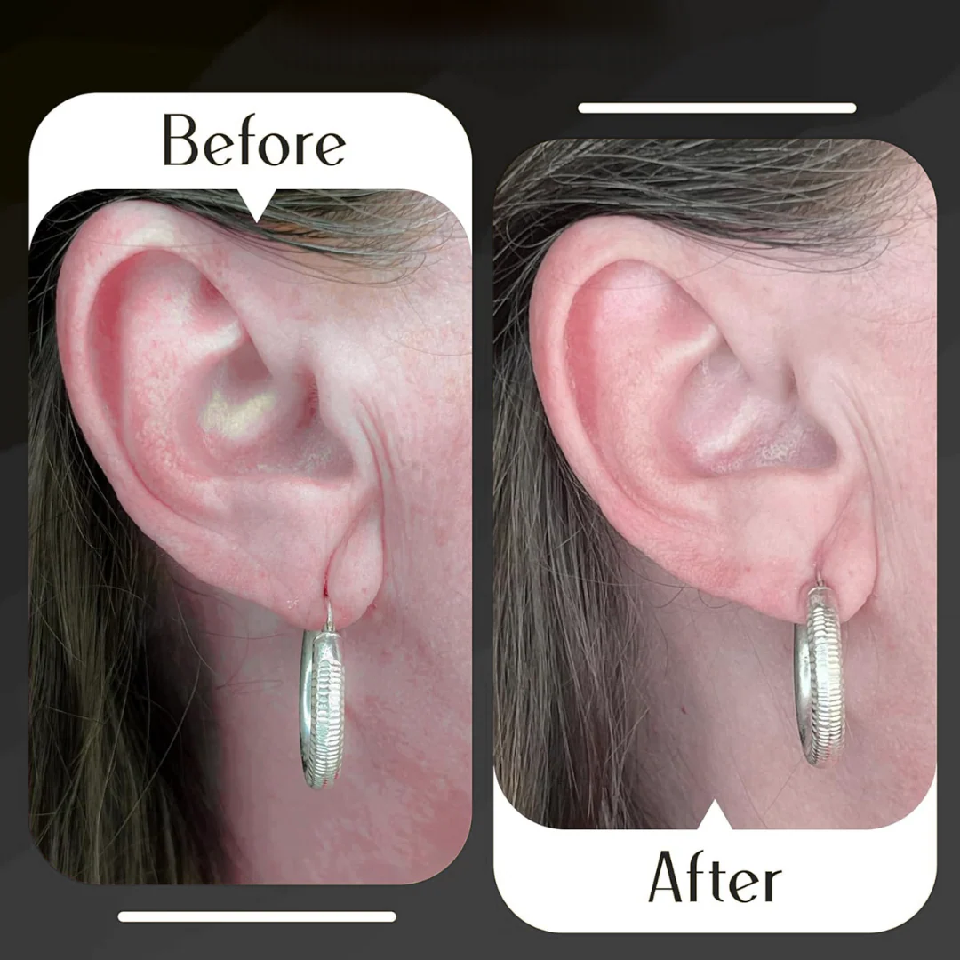 Earlobe Support Patches